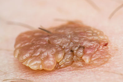 Close-up photo of a wart
